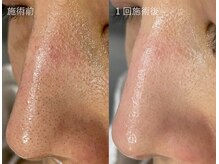 ひびき 京都烏丸御池店/お肌のトーンアップにも効果的★