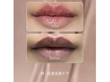 韓国発メラニンケア【ルメラ】導入!本来の肌色に戻してくれます