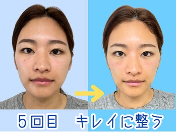 ナチュラルパーフェクトフェイス 新宿/5回目キレイに整う/新宿小顔造顔