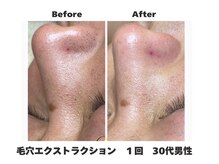 ラナン パラフューズ(Ranun's PARAFUSE.)/毛穴ビフォーアフター（4）