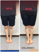 ドールアネックス/O脚を改善してまっすぐへ・・