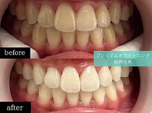 ホワイトニングカフェ 博多駅前店(WhiteningCafe)/◎歯のホワイトニング施術写真◎