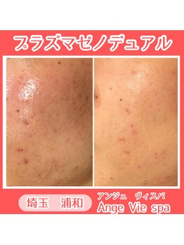 アンジュ ヴィスパ(Ange Vie Spa)/プラズマゼノデュアル