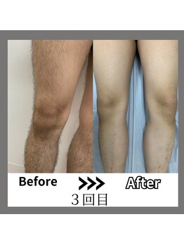 ミライキング(mirai king)/ビフォーアフター