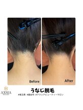 アクシア ビューティー サロン(AXSIA)/【うなじ脱毛BeforeAfter】