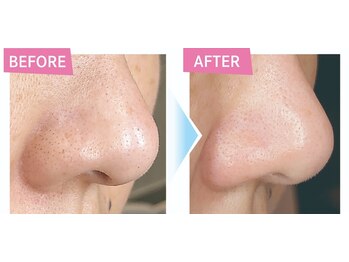 ワックス脱毛サロン アルスタ(ALUSTA)/