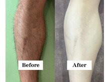 ワイイーサロン(Y/E SALON)/【30代男性　全身脱毛】