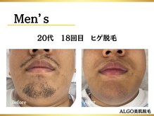 アルゴ 堺東駅前店(ALGO)/20代/ヒゲ脱毛/18回目