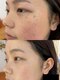 ビューティーリゾートリー(麗)の写真/痛みの少ないシミケアで効果実感！顔・身体のシミケアおすすめ◎薄いシミにも対応♪