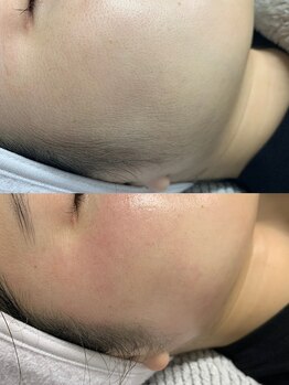 ネイルビューティー アンドエム(Nail Beauty & M)の写真/【顔のワックス脱毛で美肌の土台作り♪】目指せプルン肌！産毛や角質を取り除き、肌本来の輝きへ導きます◎