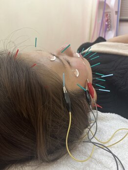 かげやま鍼灸接骨院/当院大人気の美容鍼！