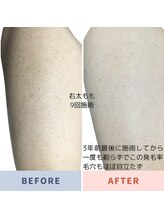 エピラージュ 町田店/全身脱毛