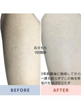 エピラージュ 町田店/全身脱毛