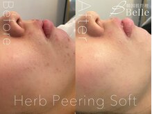ベル 町田(Belle)/ハーブピーリング|ニキビケア