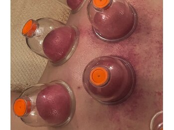 スイクウ ネオ(neo)/カッピング