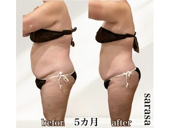 ナチュラル ビューティー スタイル さらさ(Natural Beauty Style)/さらさ痩身プログラム3カ月後