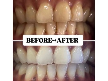 ホワイトニングサロン 豊中/Before&After美白ホワイトニング