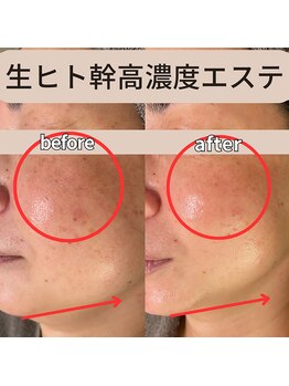 モーイエンチャーム(mooi en charme)/生ヒト幹細胞高濃度導入エステ★