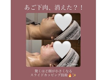 エクラ(eclat)の写真/あご下肉、即リセット。独自のスライドカッピング法だからこそだせる結果◎むくみ一掃、小顔形成が得意！