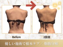 ビーシャルム(b.ChaRme)/脂肪分解で脂肪に徹底アプローチ