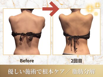 ビーシャルム(b.ChaRme)/脂肪分解で脂肪に徹底アプローチ