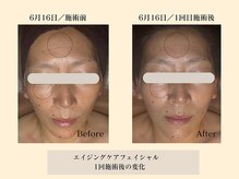 パンセリーノ(Panselinos)/エイジング120分コース　1回目