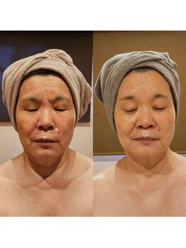 ルクス 富士宮店(Lux)の写真/【ほうれい線やたるみでお悩みの方へ】口元の影や年齢肌のケアに★大人向けエイジングケア◎