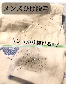 ゲッカ(GEKKA)/メンズひげ脱毛