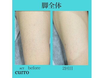 アクト クロ(ACT curro)/【脚全体】脱毛施術例