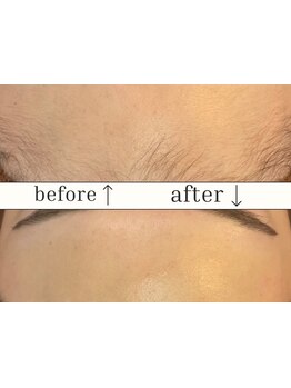 顔脱毛がしたい