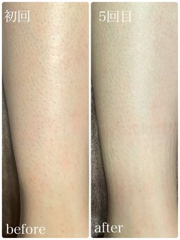 イーストモア(EAST MOIS)/5回でスベスベ