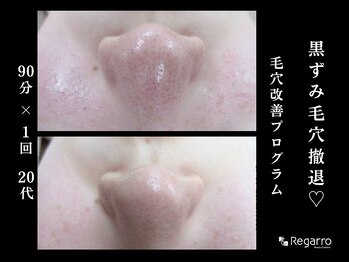 レガロビューティクリエイションズ桜川店/脱・黒ずみ！毛穴改善プログラム