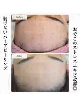 ラヴェンナサロン 札幌店(Ravenna salon)/ストレスニキビも改善！