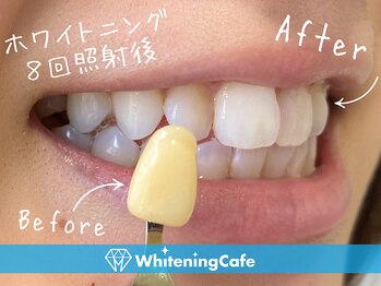 ホワイトニングカフェ 金沢店(WhiteningCafe)/◎歯のホワイトニング施術写真◎