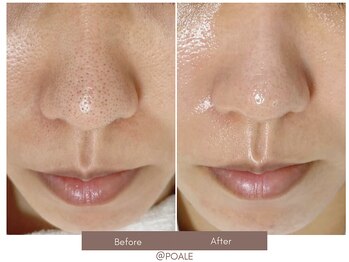 ポアレ 熊谷店(POALE)/ 毛穴ケア症例【埼玉/熊谷】