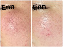 サロンエン(salon Enn)/プラズマニアでの変化♪