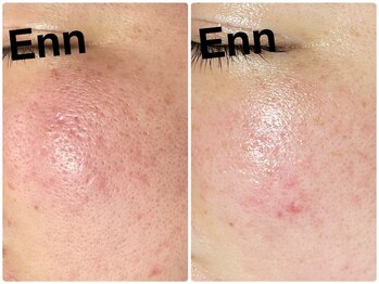 サロンエン(salon Enn)/プラズマニアでの変化♪