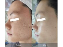 プライベートエステティックサロン アメジスト(AMETHYST)/ダクトピール症例写真３