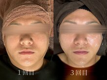 韓国式ニキビ改善、シワ、毛穴縮小＝コールドプラズマ