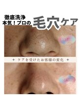 ロビナ 長野駅前店(Lovina)/ビフォーアフター(毛穴洗浄)