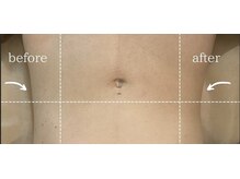 小顔専門店Lift(リフト)新宿西口/小顔専門店Lift｜Before After