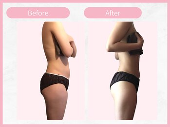 RHB 横浜店/【痩身コース】ビフォーアフター