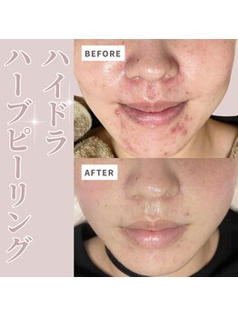 ベル(Belle)の写真/頑固でなかなか治らない肌荒れは【水素ハイドラ×ハーブピーリング】このセットは最強！