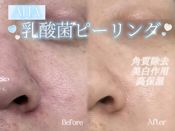 アザレア 新宿店(AZALEA)の写真/【つるん素肌へ】★乳酸菌ピーリング★古い角質をやさしくオフ→うるおいキープ→なめらか透明感肌へ！