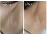 【脇の黒ずみ・ブツブツ何とかしたい！】剥離なし☆フォト付ハーブピーリング