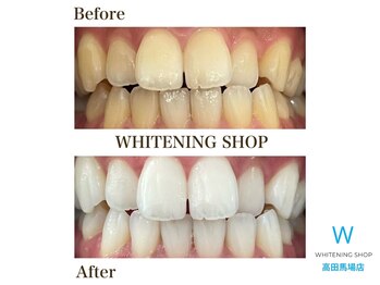 ホワイトニングショップ 高田馬場店/ホワイトニングビフォーアフター