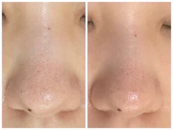 ホワイトアクア 広島店(WHITE AQUA)/ハーブピーリング/毛穴ケア