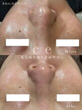 シャルム エスボーテ(charme Esbeaute)/ハーブピーリング肌質改善