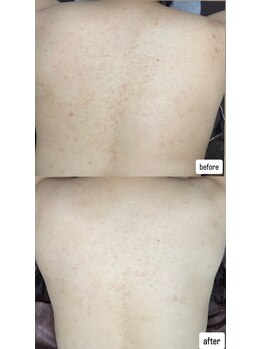 ベラージュ 高崎/お客様の症例★背中エステ