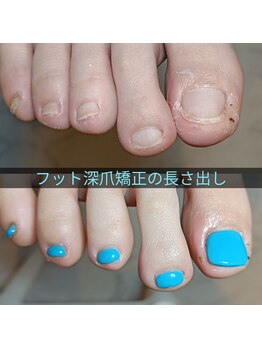 マニエネイル(mani e nail)/もう隠さない！フットの深爪矯正